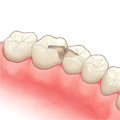 虫歯部分の除去