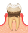 歯周病１
