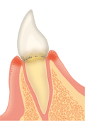 前歯の歯肉炎