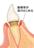 前歯の軽度歯周病　文字付
