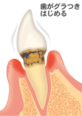 前歯の中度歯周病　文字付